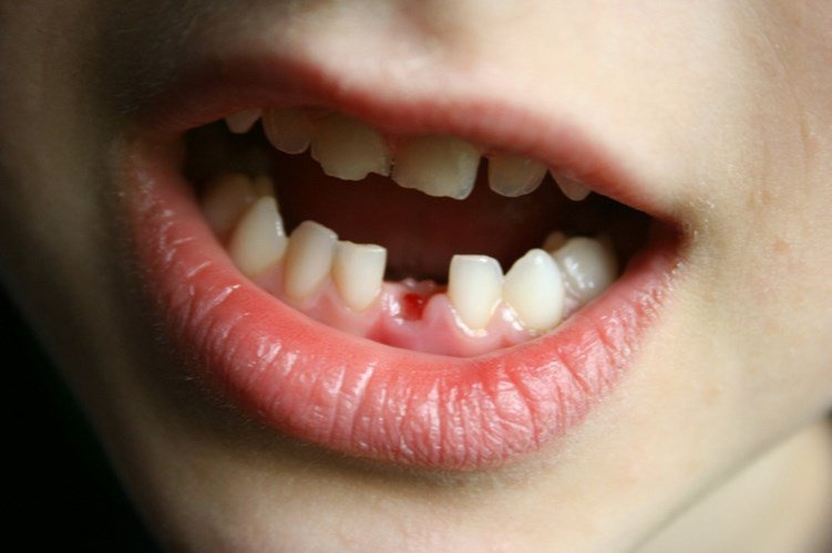 Giải mã giấc mơ thấy gãy răng chảy máu: Điềm báo tốt hay xấu?